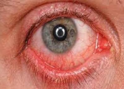 اشک چشم مبتلایان کرونا، آلوده به ویروس است